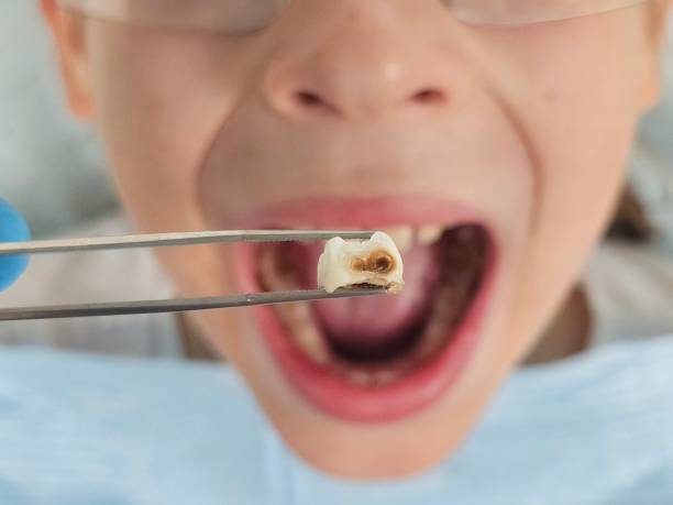 Best Broken or Cracked Tooth Emergency Dentist in Broken Bow, NE